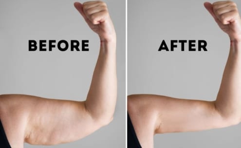 brachioplasty before and after