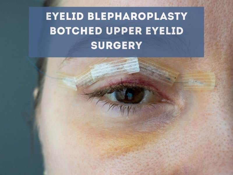 eyelid blepharoplasty botched upper eyelid surgery