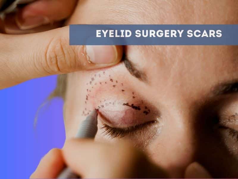 eyelid surgery scars