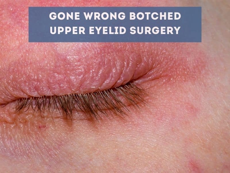 gone wrong botched upper eyelid surgery