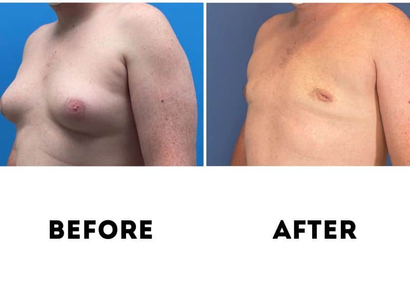 gynecomastia before and after surgery