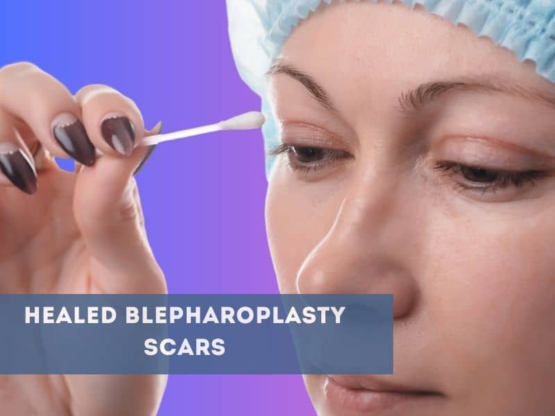 healed blepharoplasty scars