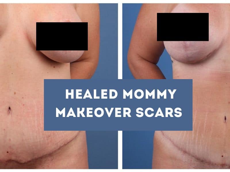 healed mommy makeover scars