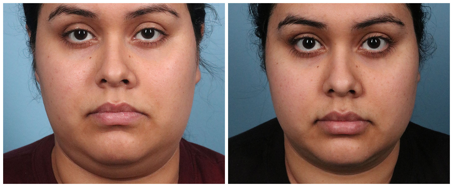 Chin Liposuction in Sugar Land, Cost and Photos