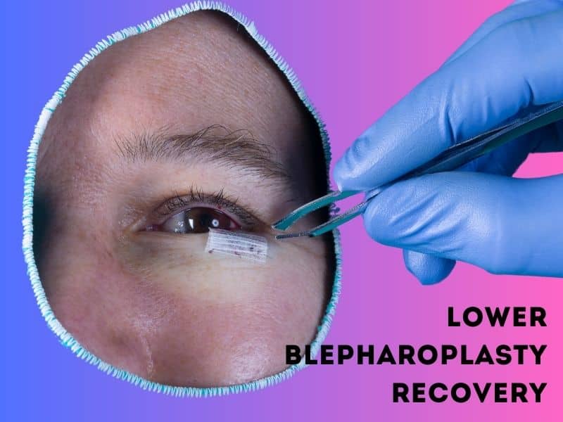 lower blepharoplasty recovery
