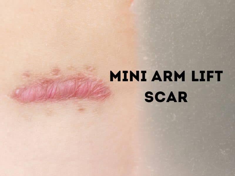 mini arm lift scar